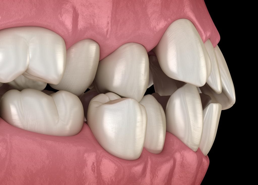 misalignment of teeth